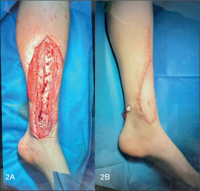 A GAME-CHANGER IN FREE-TISSUE SURGERY: THE FUTURE'S BRIGHT, THE FUTURE'S FLUORESCENT….