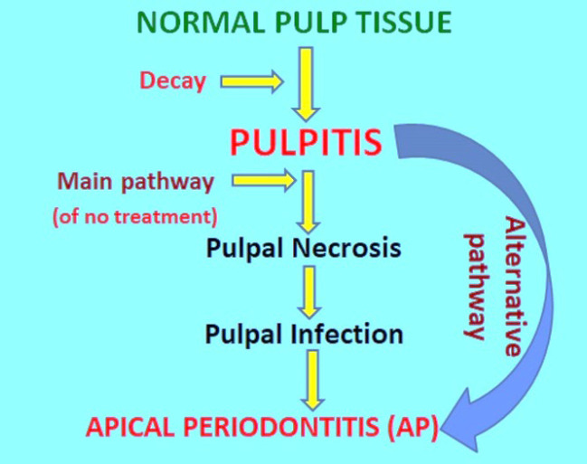 Apical Periodontitis in Vital and Nonvital Teeth: Clinical and Radiographic Features.