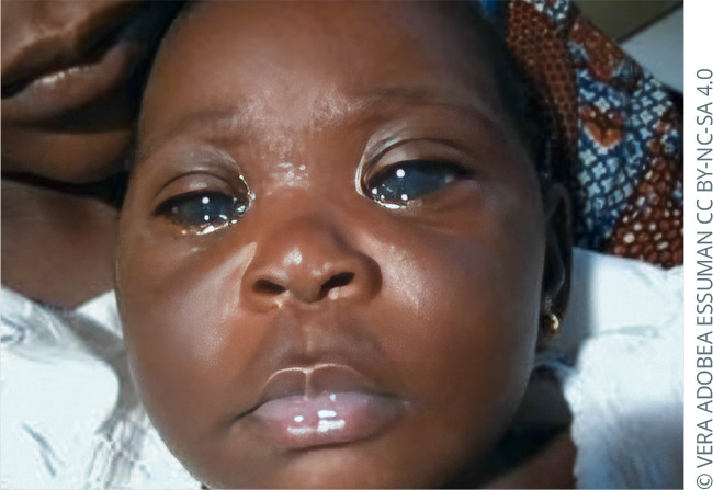 Congenital glaucoma: the 'not-so-silent' thief of sight in children.