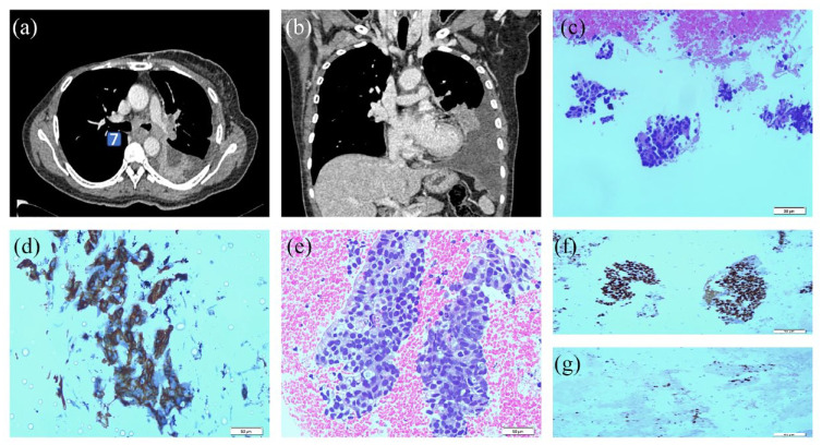 Early experience of endobronchial ultrasound-guided transbronchial nodal cryobiopsy: a case series from Sabah, Malaysia.