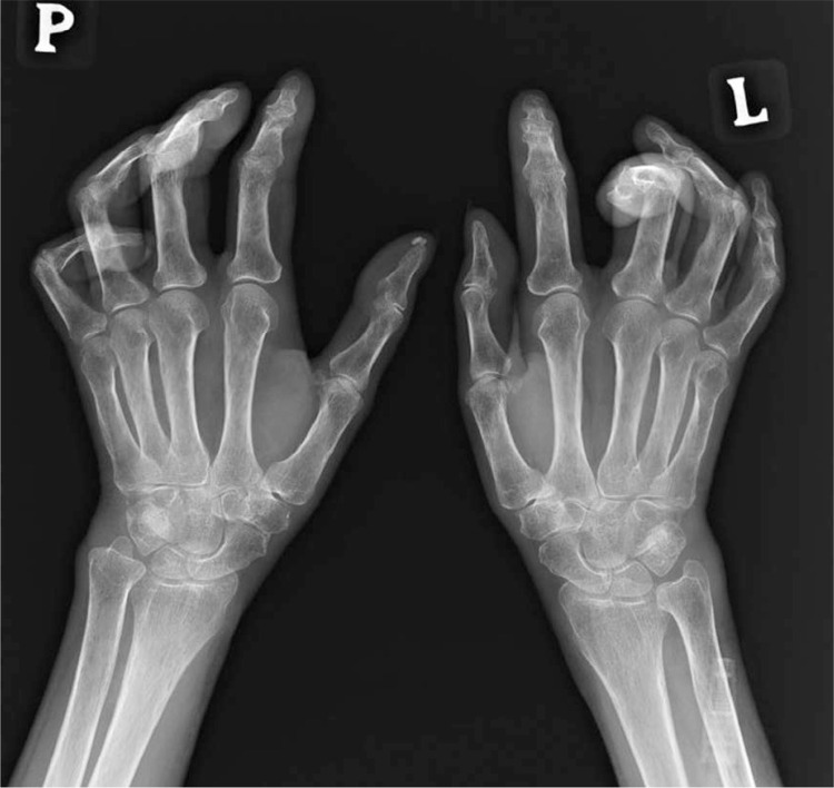 Musculoskeletal involvement in systemic sclerosis.