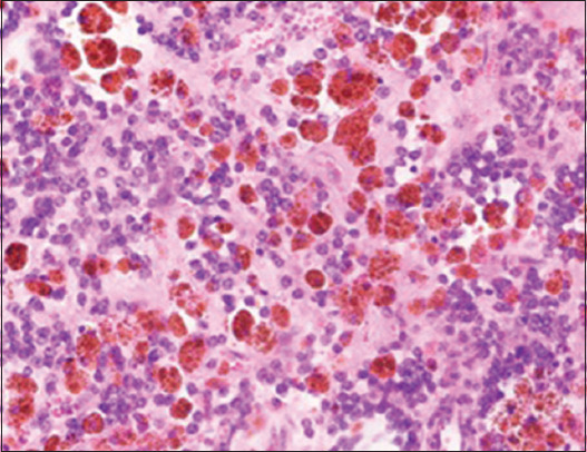 Pediatric Ewing Sarcoma of Kidney: A Case Series and Review of Literature.