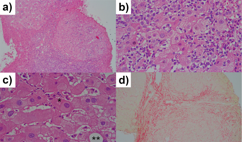 Molecular genetic association of rs8099917 and rs1800795 polymorphisms in the progression of hepatitis Delta virus liver disease.