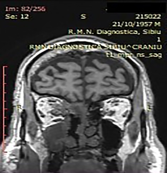 Magnetic Resonance Imaging in COVID-19 Associated Rhino-Sinusal Mucormycosis.