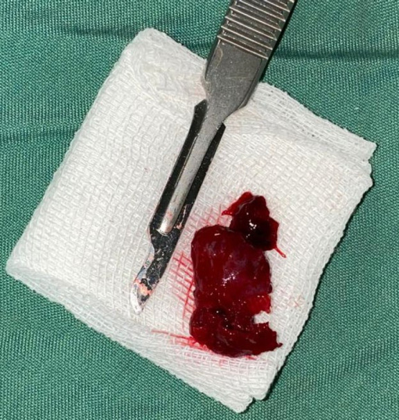 Successful Combined Treatment Approach for Central Giant Cell Granuloma: A Case Study of Surgery Following Intralesional Steroid Injection.
