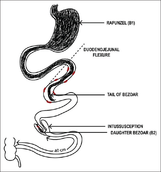 A Convoluted Tale of Rapunzel Tail: With Dislodged Daughter Bezoar as Lead Point for Intussusception.