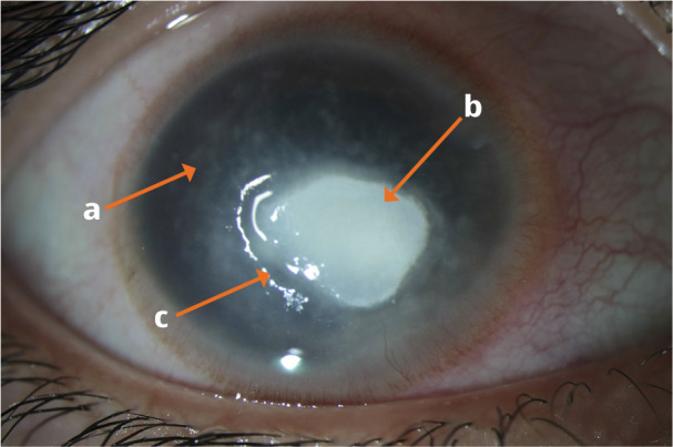 <i>Pythium insidiosum</i>: the organism that mimics fungal keratitis.