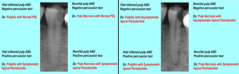 Apical Periodontitis in Vital and Nonvital Teeth: Clinical and Radiographic Features.