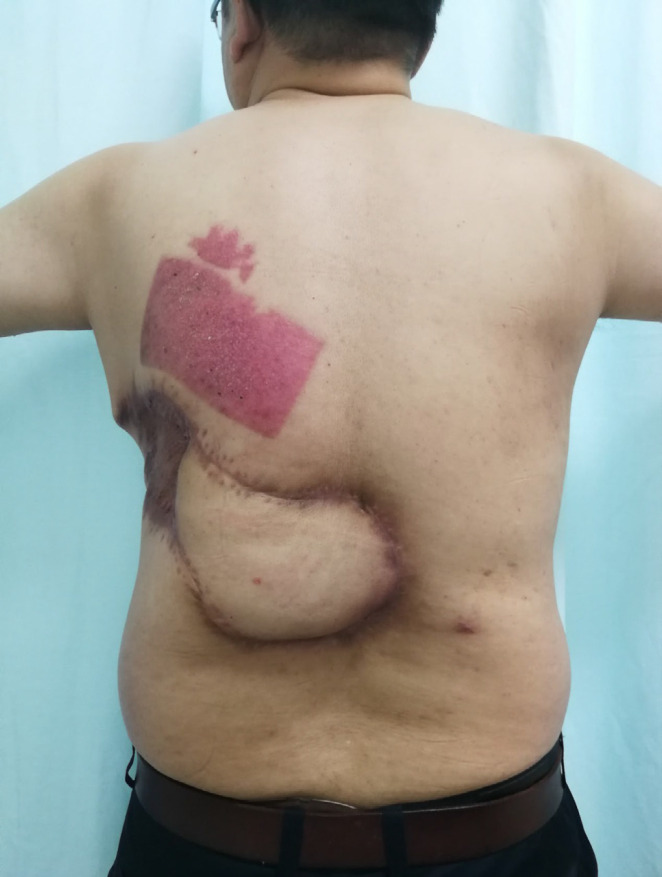 Reverse Turnover Pedicled Latissimus Dorsi Muscle Flap for the Repair of Radiation Ulcer in the Back: A Case Report.