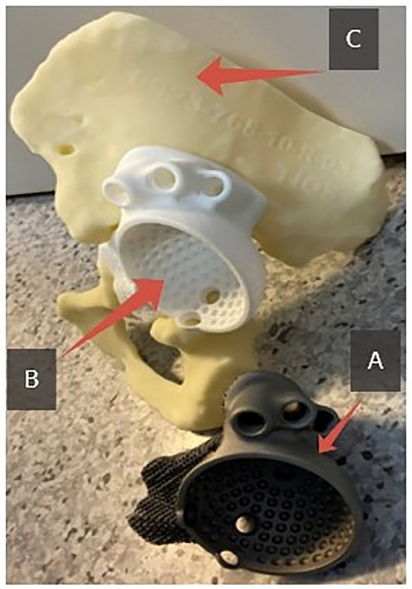 Does the interface between individual 3D acetabular implants and host bone influence the functional outcomes in patients with severe bone loss after revision surgery?