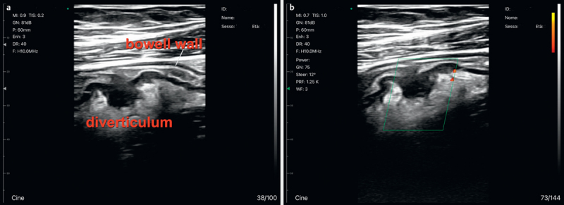 Bedside Clinical Hand-held Ultrasound in an Internal Medicine Department: The "Bed Med-Us" Experience of Codogno and its Clinical Utility in the Management of Diagnosis and Therapy in 1007 Patients.