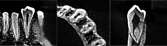 Evaluation of Root Canal Morphology of Mandibular Premolars Using Cone-beam Computed Tomography in Golestan Province, North of Iran.