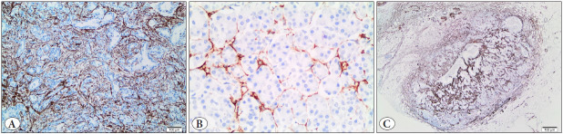 The Importance of Stroma and Stromal SMA Expression in Pancreatic Ductal Adenocarcinoma.