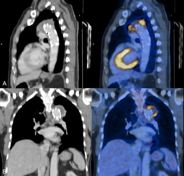 <sup>18</sup>F-FDG PET CT in cardiac device infections - A Case series.