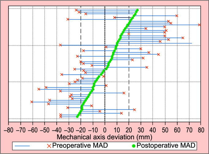 Computer Hexapod-assisted Orthopaedic Surgery for the Correction of Multiplanar Deformities throughout the Lower Limb.