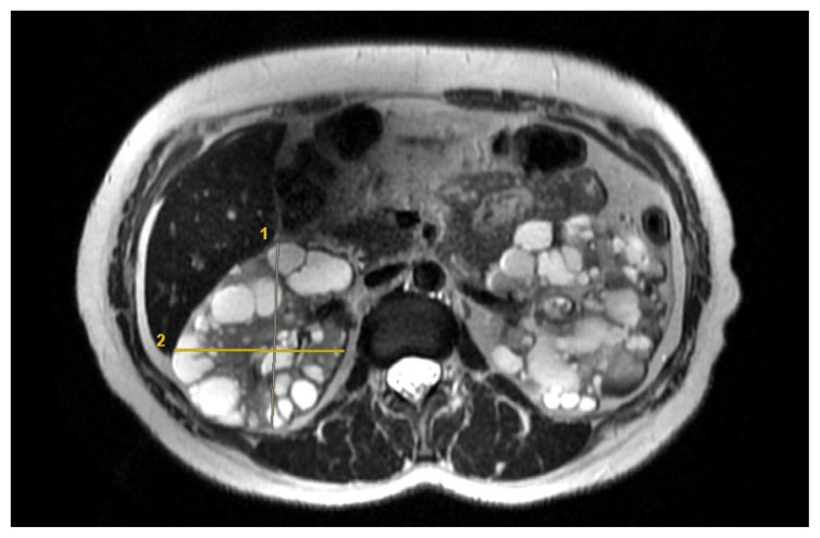 Total kidney volume in autosomal dominant polycystic kidney disease: intraobserver and interobserver agreement of two methods with MRI.