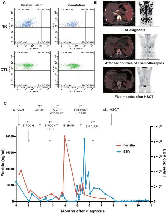 Relapsed/Refractory Peripheral T-Cell Lymphoma-Associated Hemophagocytic Lymphohistiocytosis With UNC13D and CD27 Germline Mutations.