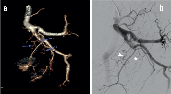 Assessement of Radiological Anatomy of Prostatic Artery on 3D DECT in Symptomatic Benign Prostatic Hypertrophy.