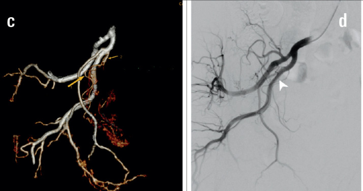 Assessement of Radiological Anatomy of Prostatic Artery on 3D DECT in Symptomatic Benign Prostatic Hypertrophy.