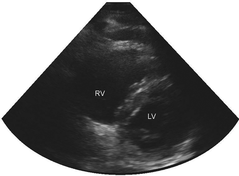 Peripartum Abdominal Compartment Syndrome Following Extracorporeal Hemodynamic Support.