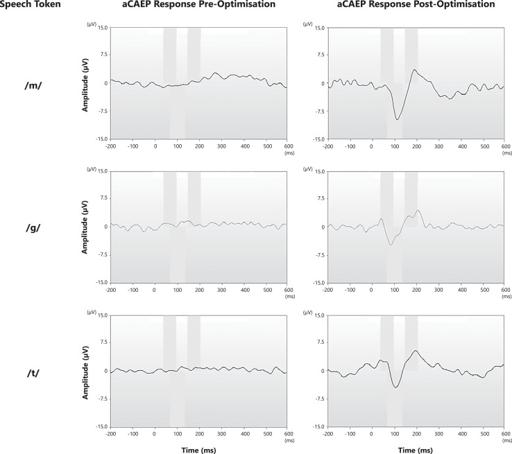 The Impact of Patient Factors on Objective Cochlear Implant Verification Using Acoustic Cortical Auditory-Evoked Potentials.