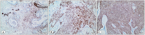 The Importance of Stroma and Stromal SMA Expression in Pancreatic Ductal Adenocarcinoma.