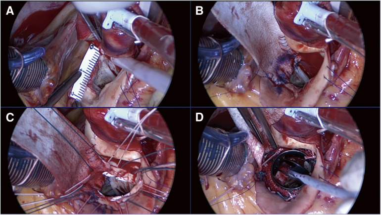 Aortic Annular Enlargement with Modified Y-Incision Technique Devised from Preoperative Three-Dimensional Computed Tomography.