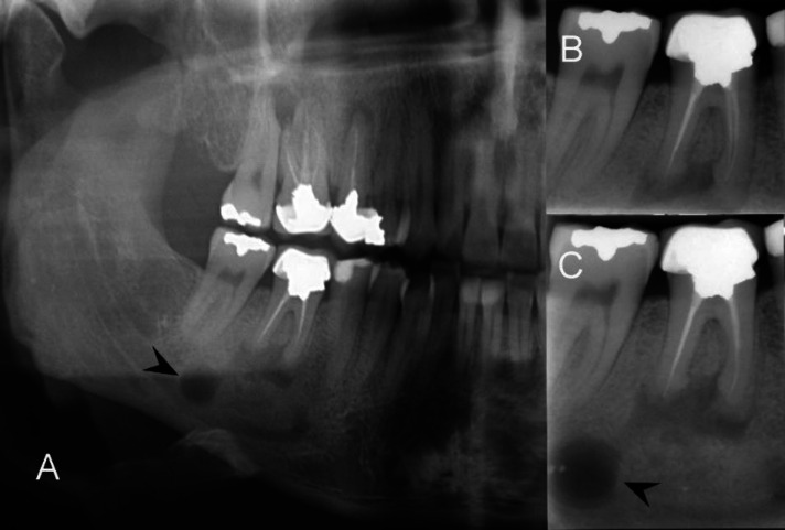 Successful Management of a Rare Distant Endodontic Lesion: A Case Report.