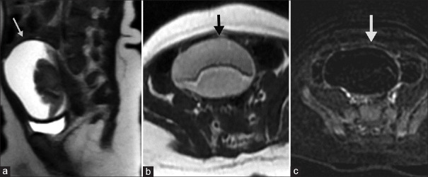 Laparoscopic Management of Auto-Amputated Ovarian Cyst in an Infant.