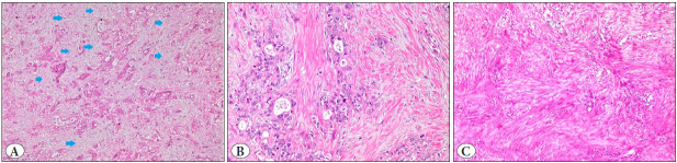 The Importance of Stroma and Stromal SMA Expression in Pancreatic Ductal Adenocarcinoma.