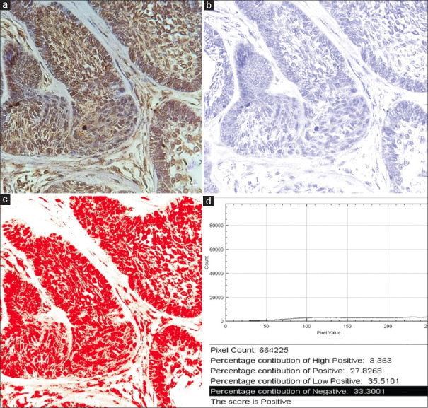 Immunohistochemical evaluation of yes-associated protein molecule in the odontogenic epithelium of different histopathological variants of ameloblastoma and unicystic ameloblastoma.
