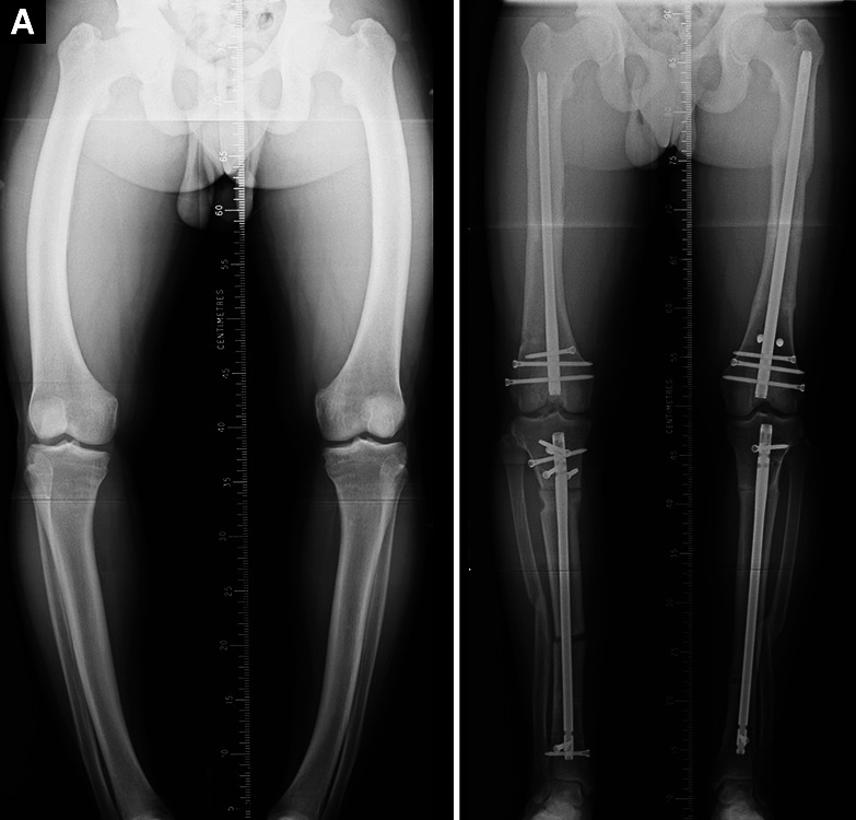 Computer Hexapod-assisted Orthopaedic Surgery for the Correction of Multiplanar Deformities throughout the Lower Limb.