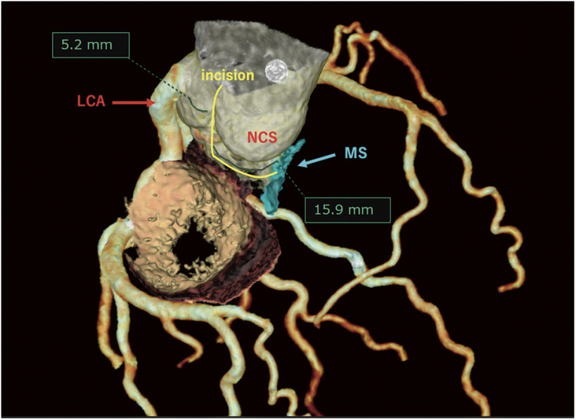 Aortic Annular Enlargement with Modified Y-Incision Technique Devised from Preoperative Three-Dimensional Computed Tomography.
