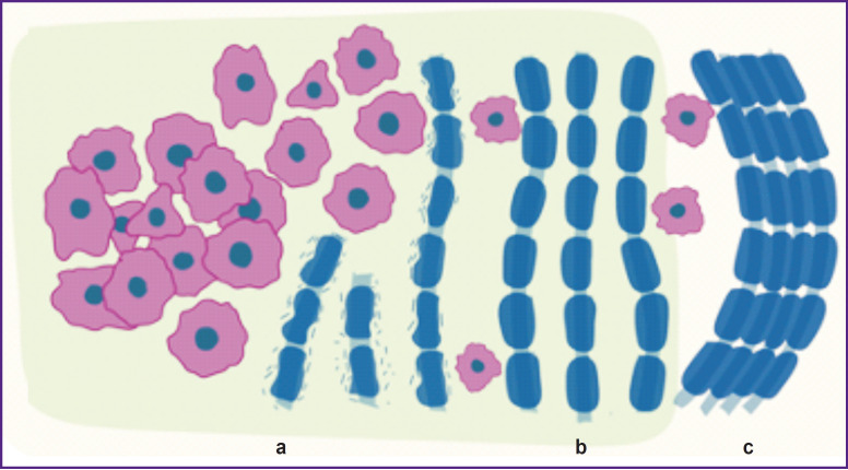 Peritumoral Brain Zone in Astrocytoma: Morphology, Molecular Aspects, and Clinical Manifestations (Review).