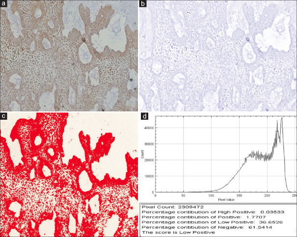 Immunohistochemical evaluation of yes-associated protein molecule in the odontogenic epithelium of different histopathological variants of ameloblastoma and unicystic ameloblastoma.