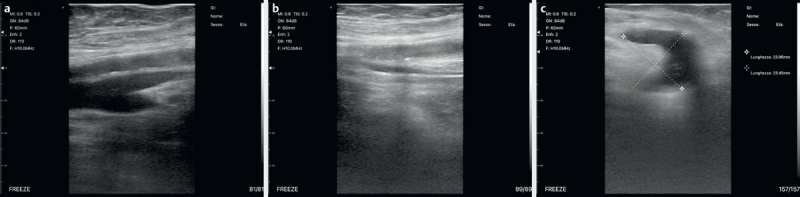 Bedside Clinical Hand-held Ultrasound in an Internal Medicine Department: The "Bed Med-Us" Experience of Codogno and its Clinical Utility in the Management of Diagnosis and Therapy in 1007 Patients.