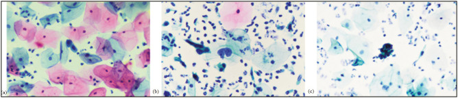 Distribution of High-risk Human Papillomavirus Genotypes in Cervical Smear Samples and Evaluation of ASC-US, LSIL, and HSIL Results.