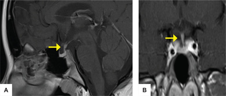Cushing Disease in a Patient with Double Pituitary Adenomas Complicated with Diabetes Insipidus: A Case Report.