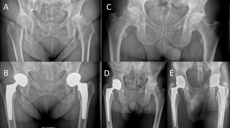 Similar complications and outcomes with simultaneous versus staged bilateral total hip arthroplasty with the direct anterior approach: A comparative study.