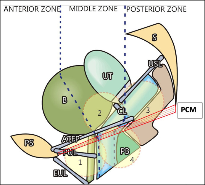 Hiatal expansion and pelvic organ prolapse - the association is not causation.