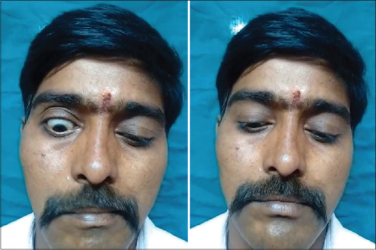 Marcus Gunn Syndrome - A Rare Neural Misdirection Phenomenon Case Report.