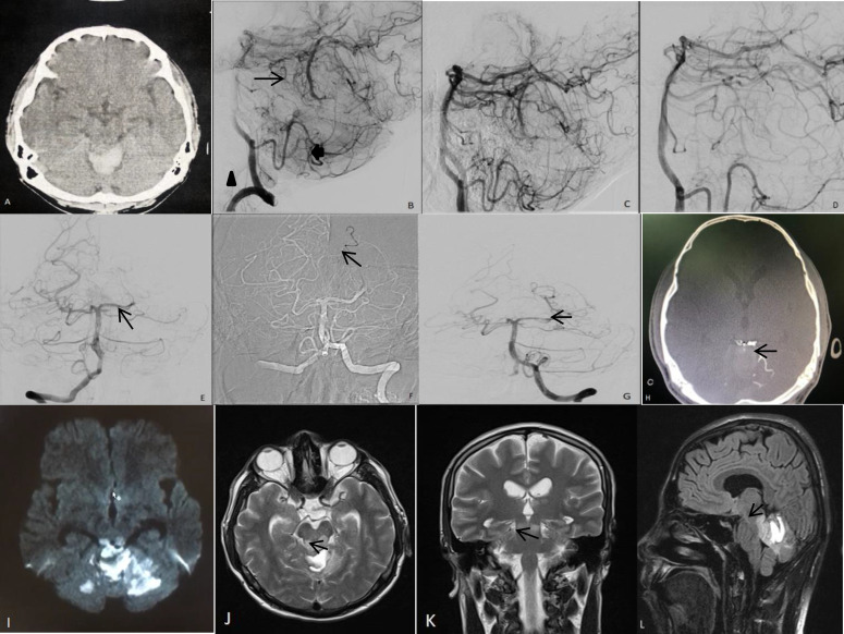 Tinnitus and reduced word recognition with a bilateral inferior colliculus infarction after cerebellar arteriovenous malformation embolization.