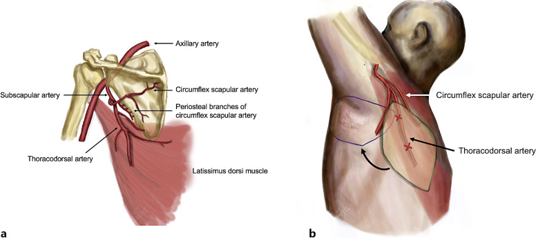 Parascapular Flap for Severe Hidradenitis Suppurativa.