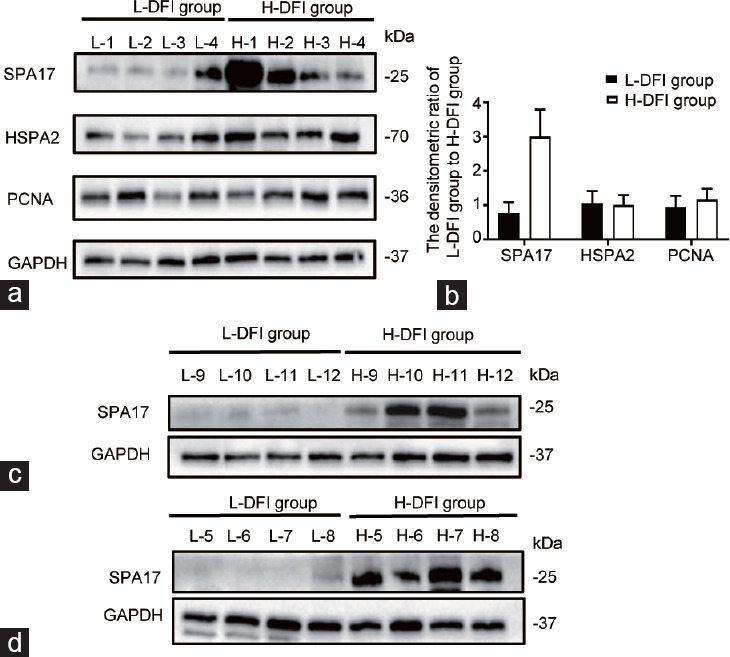 Decreased AKAP4/PKA signaling pathway in high DFI sperm affects sperm capacitation.