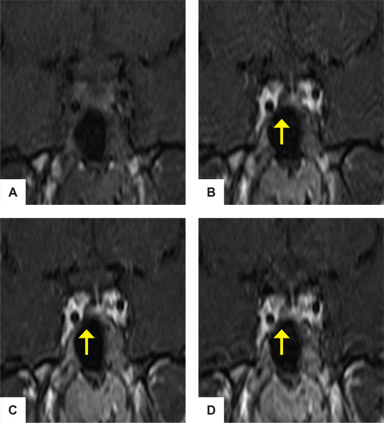 Cushing Disease in a Patient with Double Pituitary Adenomas Complicated with Diabetes Insipidus: A Case Report.