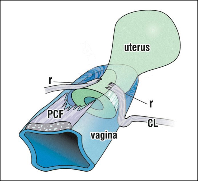Hiatal expansion and pelvic organ prolapse - the association is not causation.