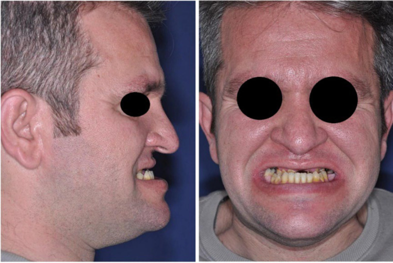 Intermaxillary Fixation Screws (IMF) & Surgery First Approach: A Novel Combination and Case Report.