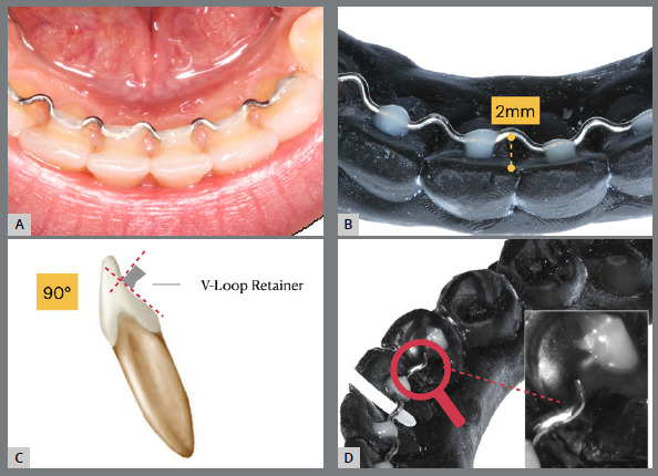 Periodontal indexes of two types of 3 x 3 retainers: 0.032-in SS V-loop versus 0.0215-in SS coaxial - a randomized crossover trial.