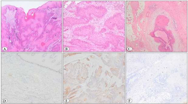 A Low-Risk HPV-Associated Well-Differentiated Squamous Cell Carcinoma of the Cervix with Low-Grade Squamous Intraepithelial Lesion Morphology: Clinical and Pathologic Diagnostic Difficulties and Review of the Literature.