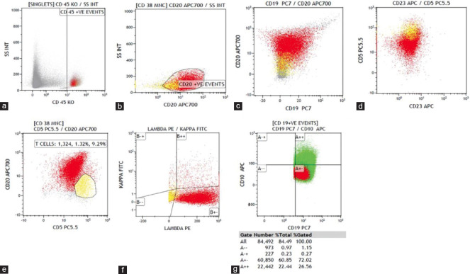 Blastoid Variant of Mantle Cell Lymphoma with Extranodal Presentation and Aberrant CD10 Expression.